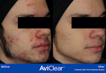 acne-treatment_Before-After-AviClear