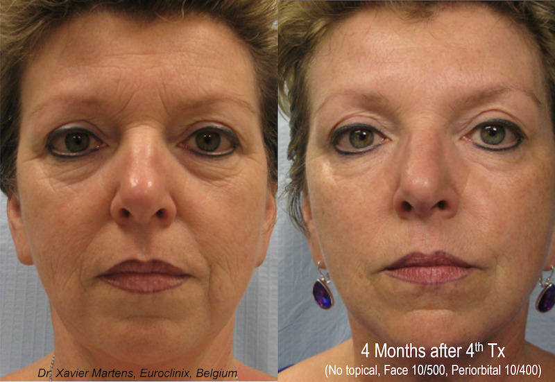 woman-before-after-tixel-CFA-Jackson-med-spa